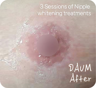 유두미백 시술 후 After nipple whitening treatment