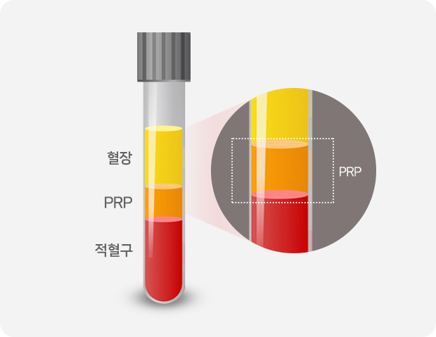 질 건조 케어 : PRP Vaginal dryness care : PRP