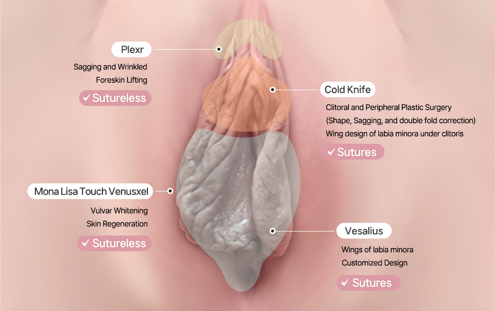 다움산부인과의 4단계 소음순성형 테크닉 Four-step technique for labiaplasty at Daum Women’s Clinic