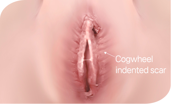 소음순 수술 후 부작용 : 톱니바퀴 모양으로 패인 자국 발생 Indented scalloped marks as a complication after labiaplasty