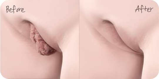 소음순 전후사진 Before and after results of labiaplasty