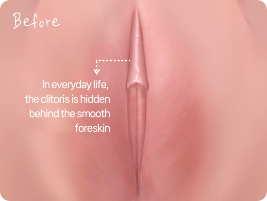 Clitoris normally concealed under smooth clitoral hood