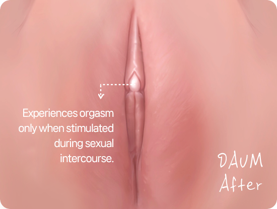 Clitoral anatomy related to stimulation during intercourse: clitoral hood surgery