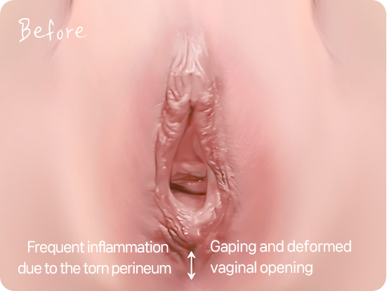 출산 후 벌어진 질입구로 회음부 성형이 필요한 경우 Post-childbirth widened vaginal opening requiring perineal repair