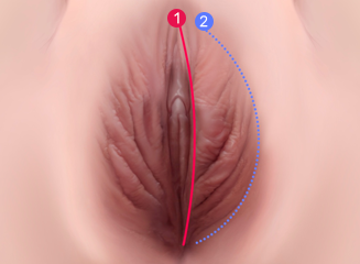 대음순 축소 수술 방법 Labia majora reduction surgery method
