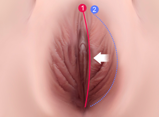대음순 축소 수술 방법 Labia majora reduction surgery method