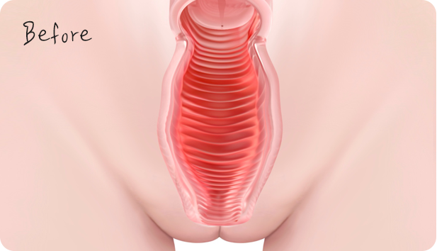 질필러 시술 전 Vaginal tightening filler