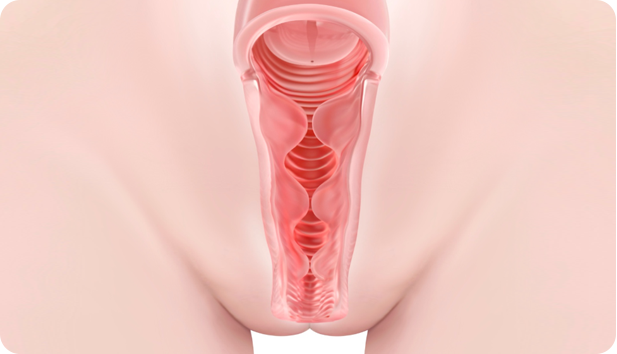 원더필 질필러 시술 후 Wonder fill : Vaginal tightening filler