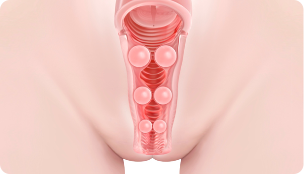 HA 쿠션 질필러 시술 후 HA : Vaginal tightening filler