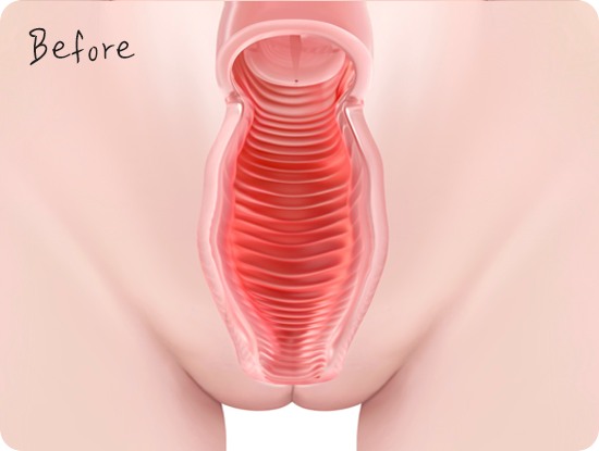 질축소 필러 Vaginal tightening filler before