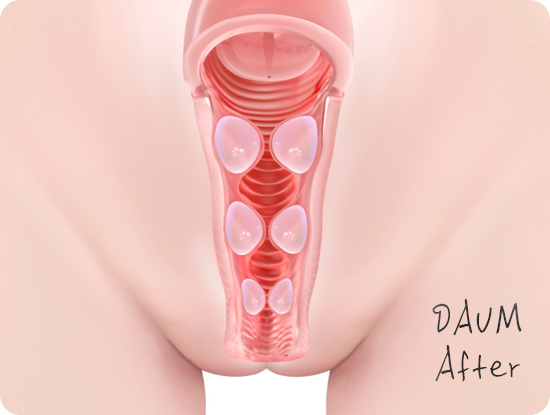 질필러 Vaginal tightening filler 