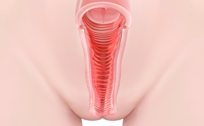 보형물 없는 질 축소수술 Non-implant vaginal tightening surgery