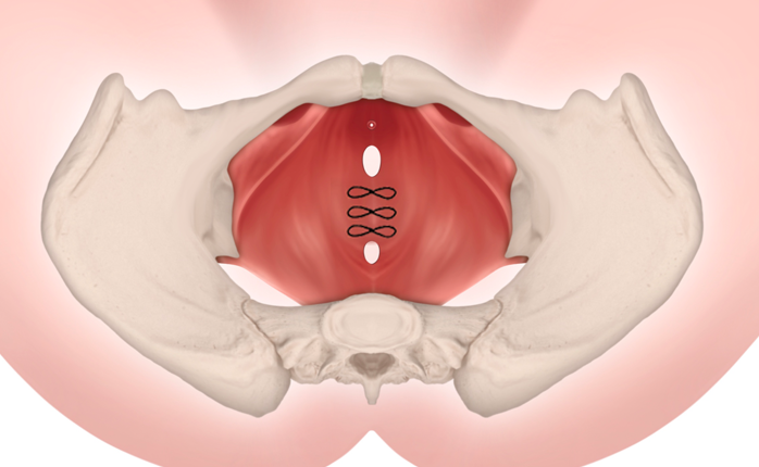 늘어진 인대를 강화하는 질 축소수술 Vaginal tightening surgery that strengthens loosened ligaments