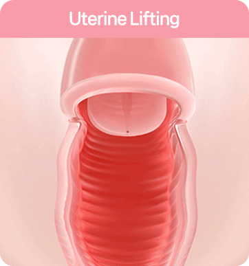 자궁경부 리프팅 : 질축소수술 Cervical lifting: vaginal tightening surgery