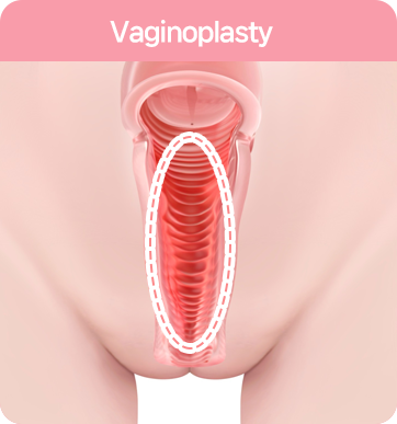 질 점막 돌기 성형술 : Vaginal mucosal ridge correction: vaginal tightening surgery