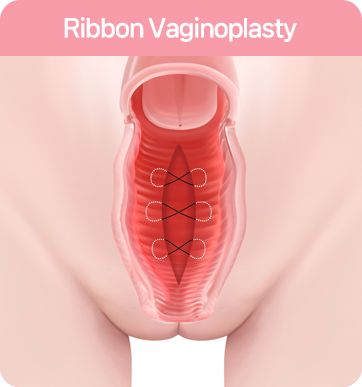 질축소수술 : 다움 리본 질성형술 Vaginal tightening surgery: Daum Ribbon Vaginal Rejuvenation