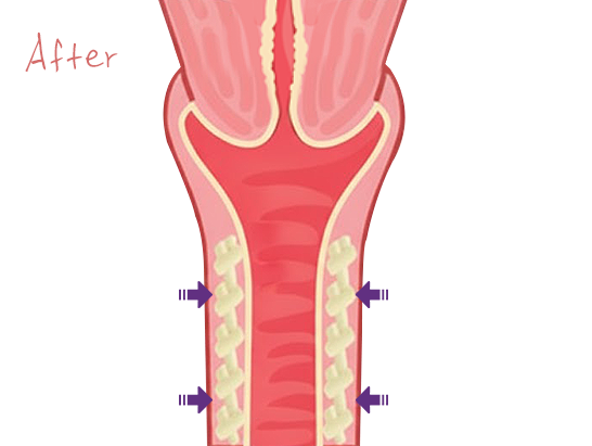 질플란트 Vaginal implant