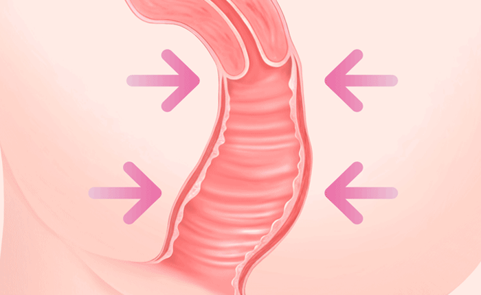 보형물 없는 질 축소수술 Non-implant vaginal tightening surgery