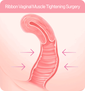 질 점막 돌기 성형술 : Vaginal mucosal ridge correction: vaginal tightening surgery