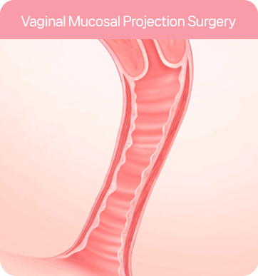 질축소수술 : 다움 리본 질성형술 Vaginal tightening surgery: Daum Ribbon Vaginal Rejuvenation